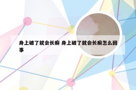 身上破了就会长癣 身上破了就会长癣怎么回事