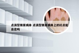 点滴型银屑病身 点滴型银屑病身上的红点能自愈吗