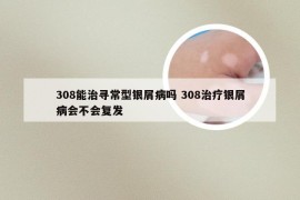 308能治寻常型银屑病吗 308治疗银屑病会不会复发