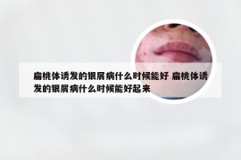 扁桃体诱发的银屑病什么时候能好 扁桃体诱发的银屑病什么时候能好起来