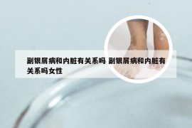 副银屑病和内脏有关系吗 副银屑病和内脏有关系吗女性