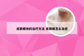 皮肤癣快的治疗方法 皮肤癣怎么治愈