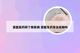 苗医苗药研了银屑病 苗医生药膏治皮癣吗