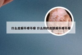 什么皮癣不疼不痒 什么样的皮肤癣不疼不痒