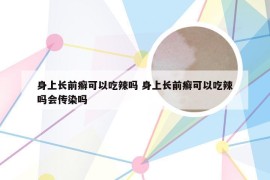 身上长前癣可以吃辣吗 身上长前癣可以吃辣吗会传染吗