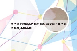 孩子腿上的癣不去根怎么办 孩子腿上长了癣怎么办,不疼不痒