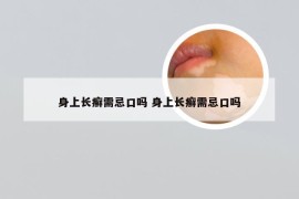 身上长癣需忌口吗 身上长癣需忌口吗