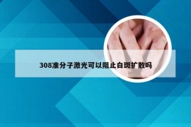 308准分子激光可以阻止白斑扩散吗