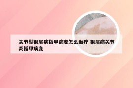 关节型银屑病指甲病变怎么治疗 银屑病关节炎指甲病变