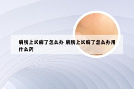 肩膀上长癣了怎么办 肩膀上长癣了怎么办用什么药