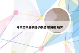 寻常型银屑病肚子都是 银屑病 肠胃