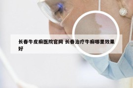 长春牛皮癣医院官网 长春治疗牛癣哪里效果好