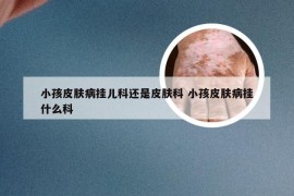 小孩皮肤病挂儿科还是皮肤科 小孩皮肤病挂什么科