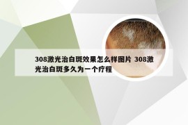 308激光治白斑效果怎么样图片 308激光治白斑多久为一个疗程