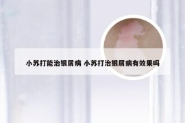 小苏打能治银屑病 小苏打治银屑病有效果吗