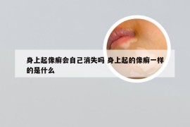 身上起像癣会自己消失吗 身上起的像癣一样的是什么