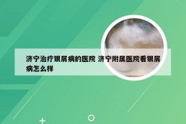 济宁治疗银屑病的医院 济宁附属医院看银屑病怎么样