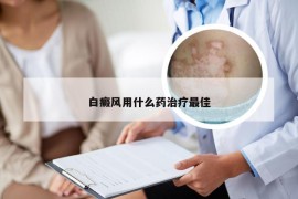 白癜风用什么药治疗最佳