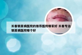 长春银屑病医院的推荐医院哪家好 长春专治银屑病医院哪个好