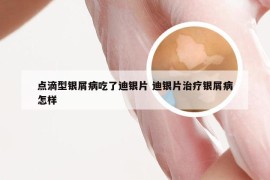 点滴型银屑病吃了迪银片 迪银片治疗银屑病怎样