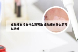 皮肤痒有没有什么药可治 皮肤痒有什么药可以治疗