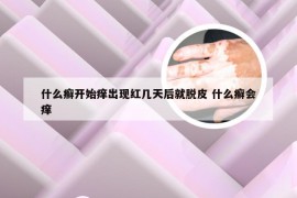 什么癣开始痒出现红几天后就脱皮 什么癣会痒