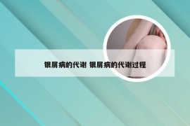 银屑病的代谢 银屑病的代谢过程