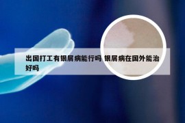 出国打工有银屑病能行吗 银屑病在国外能治好吗