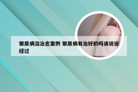 银屑病沿冶愈案例 银屑病有治好的吗请说说经过