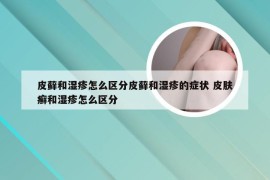 皮藓和湿疹怎么区分皮藓和湿疹的症状 皮肤癣和湿疹怎么区分