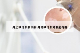 身上缺什么会长癣 身体缺什么才会起疙瘩