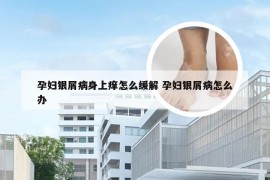 孕妇银屑病身上痒怎么缓解 孕妇银屑病怎么办