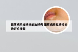 银屑病用红糖擦能治好吗 银屑病用红糖擦能治好吗视频