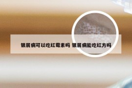 银屑病可以吃红霉素吗 银屑病能吃红方吗