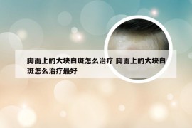 脚面上的大块白斑怎么治疗 脚面上的大块白斑怎么治疗最好