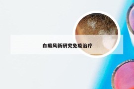 白癜风新研究免疫治疗