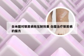 白米醋对银屑病有压制效果 白醋治疗银屑病的偏方