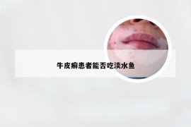 牛皮癣患者能否吃淡水鱼