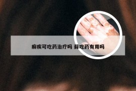 癣疾可吃药治疗吗 藓吃药有用吗