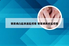 银屑病凸起表面起疙瘩 银屑病表皮起疙瘩