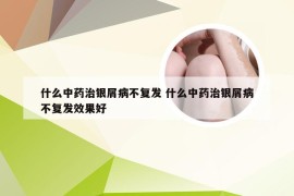 什么中药治银屑病不复发 什么中药治银屑病不复发效果好