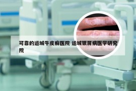 可靠的运城牛皮癣医院 运城银屑病医学研究院