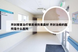 开封那里治疗银屑病效果最好 开封治癣的医院是什么医院