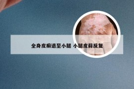 全身皮癣退至小腿 小腿皮藓反复