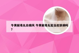 牛黄解毒丸白癜风 牛黄解毒丸能治皮肤病吗?