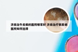 济南治牛皮癣的医院哪家好 济南治疗银屑病医院如何选择