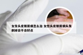 女生头皮银屑病怎么治 女性头皮银屑病头发剃掉会不会好点