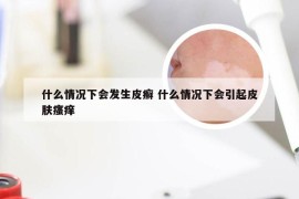 什么情况下会发生皮癣 什么情况下会引起皮肤瘙痒