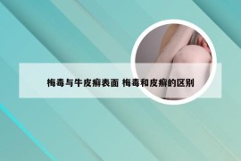 梅毒与牛皮癣表面 梅毒和皮癣的区别