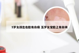 5岁女孩左右脸有白癍 五岁女宝脸上有白块